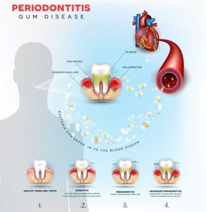 Could Periodontal Disease Be Putting Your Heart at Risk?