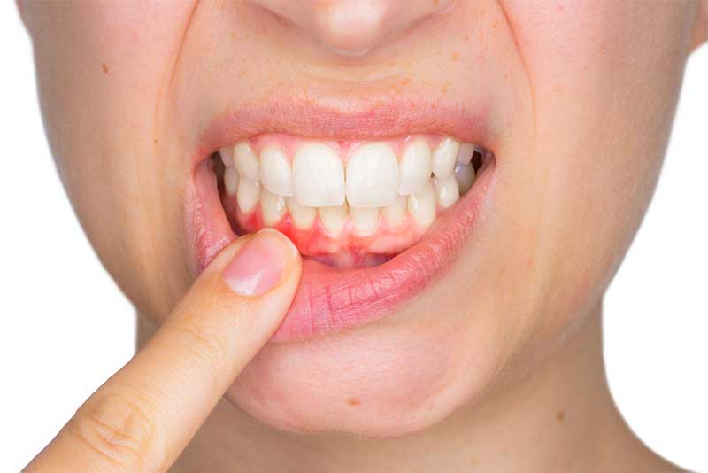 signs-of-gum-disease-strip2