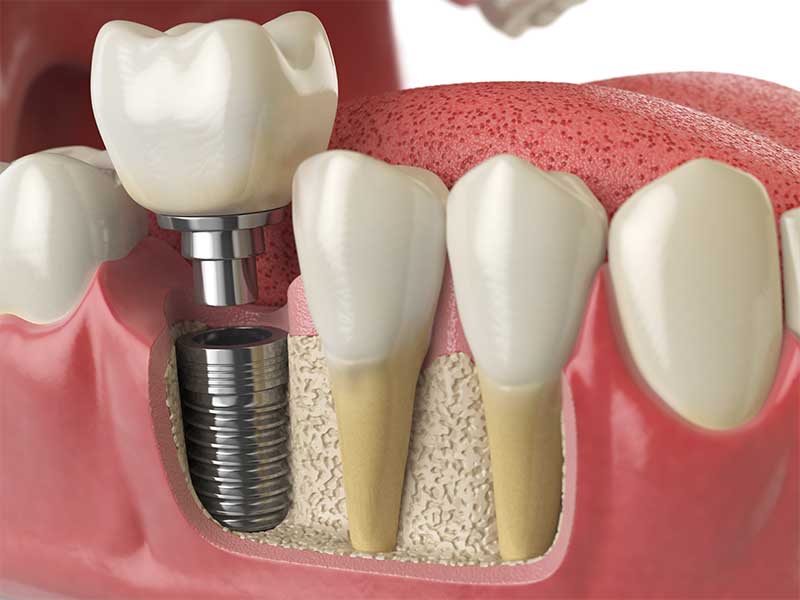 Dental Implant Procedure in Caramel Valley