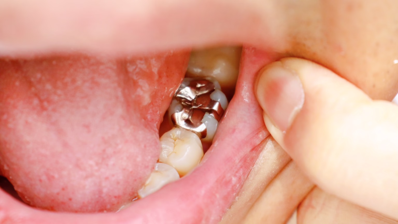 Close-up of a lower molar with a silver amalgam filling visible as a finger retracts the lip/cheek for inspection, revealing surrounding teeth and pink gum tissue.