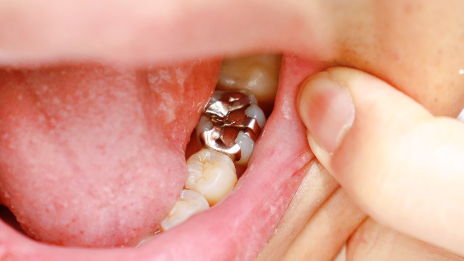 Should You Replace Silver Fillings? 8 Reasons to Consider It