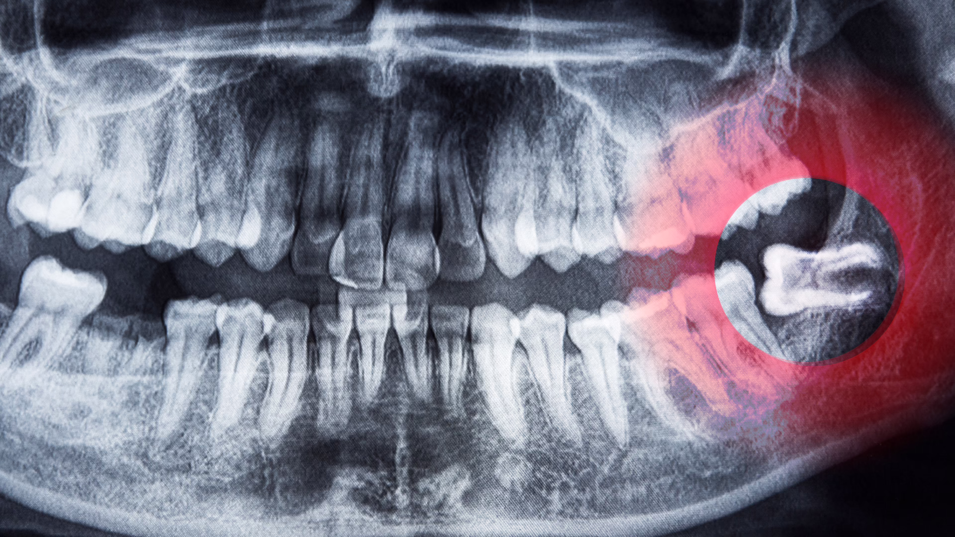 How to Tell If You Need Your Wisdom Teeth Removed